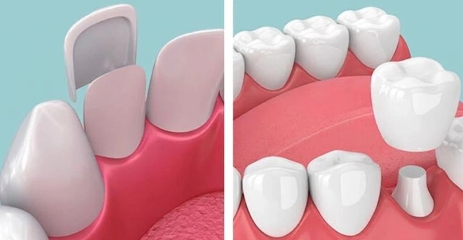 Dental Implants vs Veneers